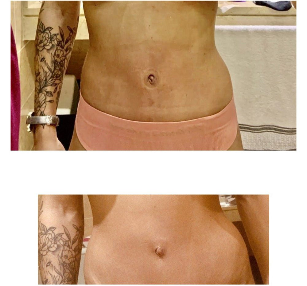 CONICAL UMBILICAL SHAPER REMODEL AND SHAPE NAVEL POST ABDOMINOPLASTY